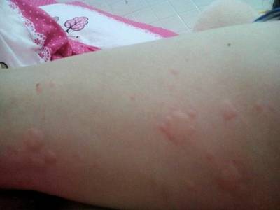大腿长大痘痘怎么回事
