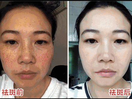 脸上突然长斑是怎么回事