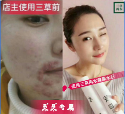 健康水 痘痘