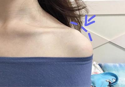 锁骨鼓起来是怎么回事