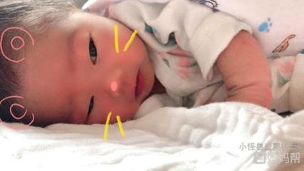 小儿黄疸值正常是多少正常