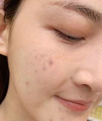 脸颊长闭口痘痘的原因分析