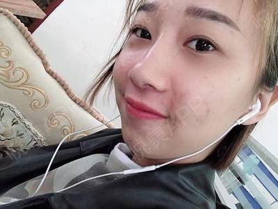 上火张痘痘疼