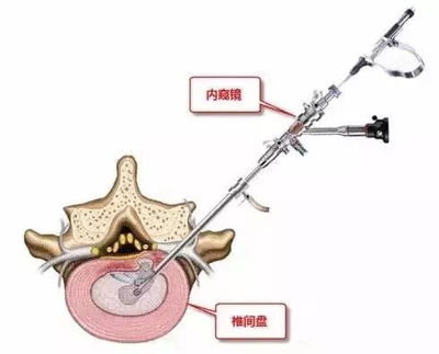 脊膜囊受压怎么治疗