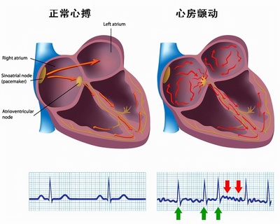 左心脏增大是怎么回事