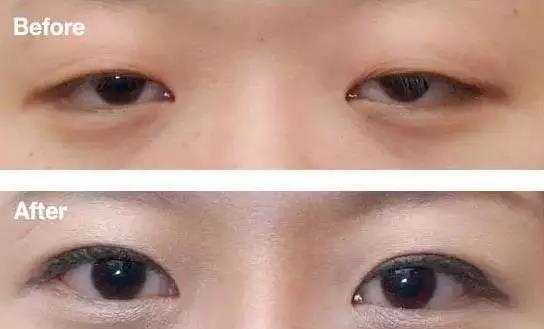 割双眼皮眼型