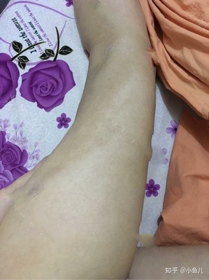 大腿抽脂的危害