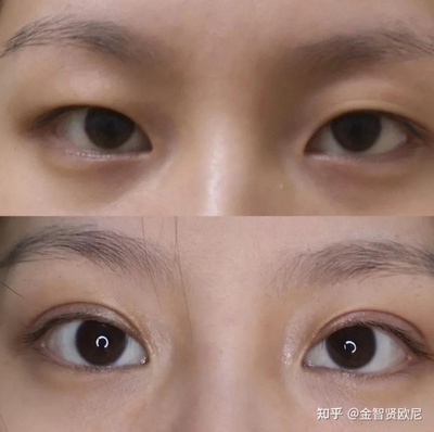 拉双眼皮