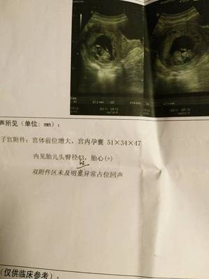 引产胎儿是活的吗