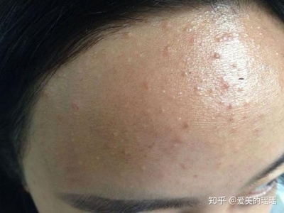 痘痘形成痤疮怎么办