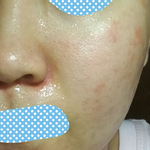 水光针治痘痘有用吗