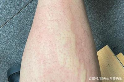 风疹是怎么回事