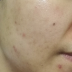 水光针治痘痘有用吗
