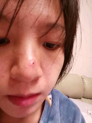 鼻子上的痘痘四个月了