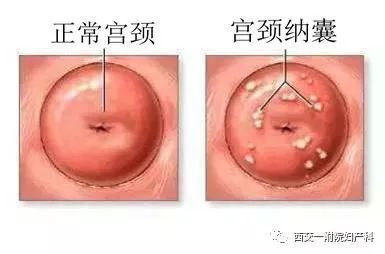 宫颈纳囊怎么治疗最好的方法