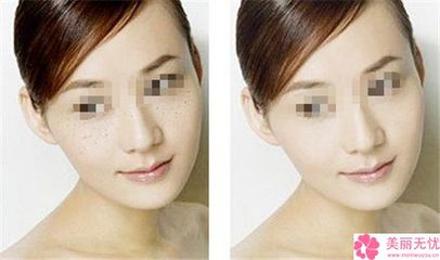 去斑美白要多少钱