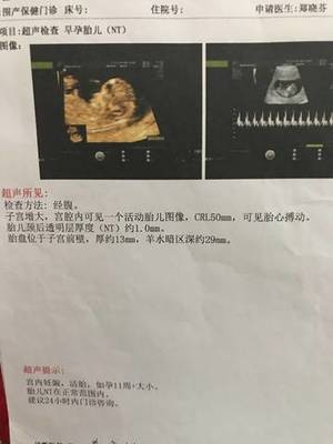孕15周胎儿