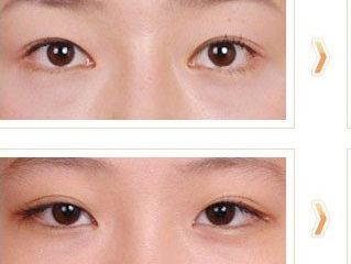 割双眼皮多久恢复呢