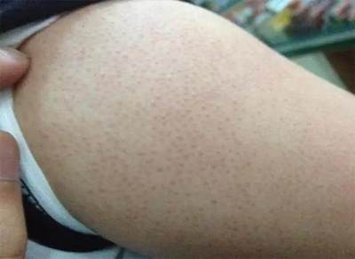 消除背部痘痘小妙招