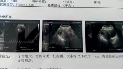 一般怀孕多久有心跳
