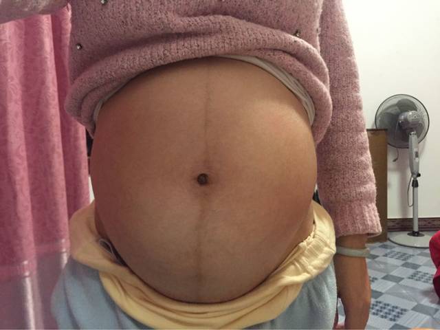 1岁宝宝肚子大正常吗