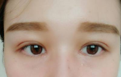 眼睛周围红是怎么回事