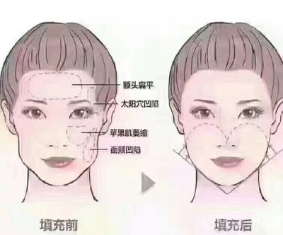 微整 脸部