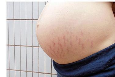 孕妇长妊娠纹的原因