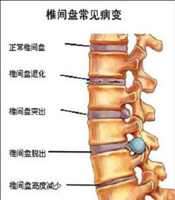 颈椎突出怎么治疗效果好