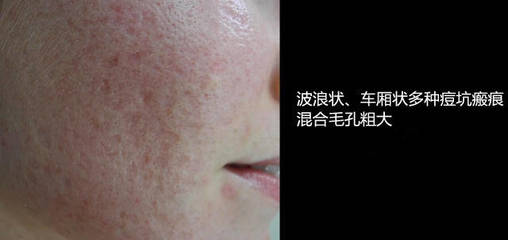 毛孔粗大痘坑
