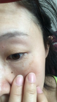 眼皮痘痘