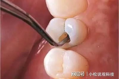 牙疼根管治疗是怎么治疗的