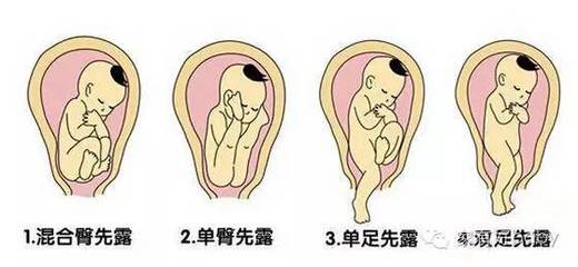 宝宝在肚子里的姿势