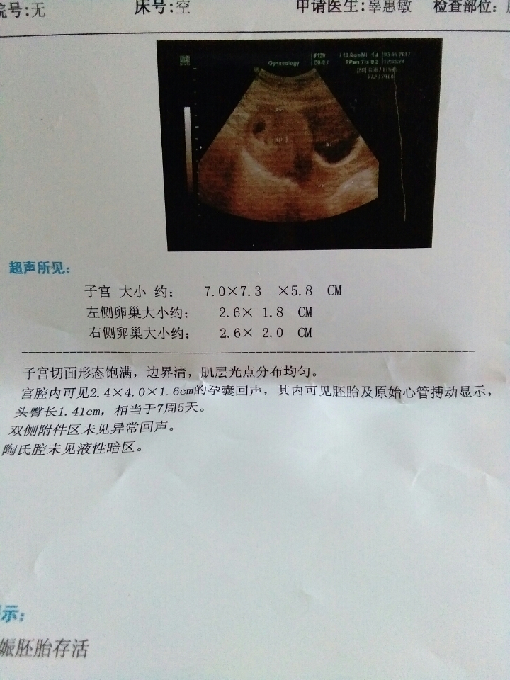 怀孕2个月最准看男女