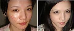 治疗脸上痘痘的中药方