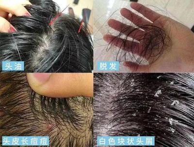头皮长痘痘有点脱发