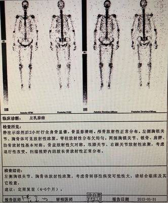 怎么治疗淋巴结节