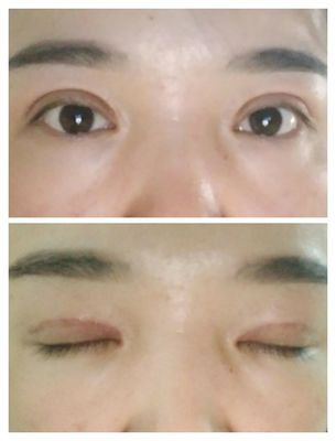 双眼皮结痂多久掉