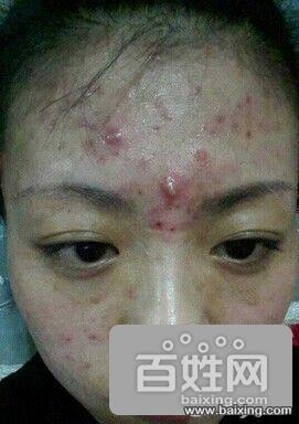 沈阳治痘痘出色肤康优