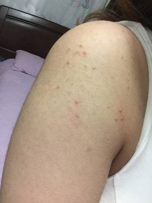 脖子到肩膀长痘痘