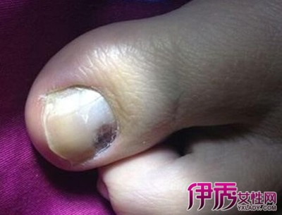 大脚指甲变黑是怎么回事