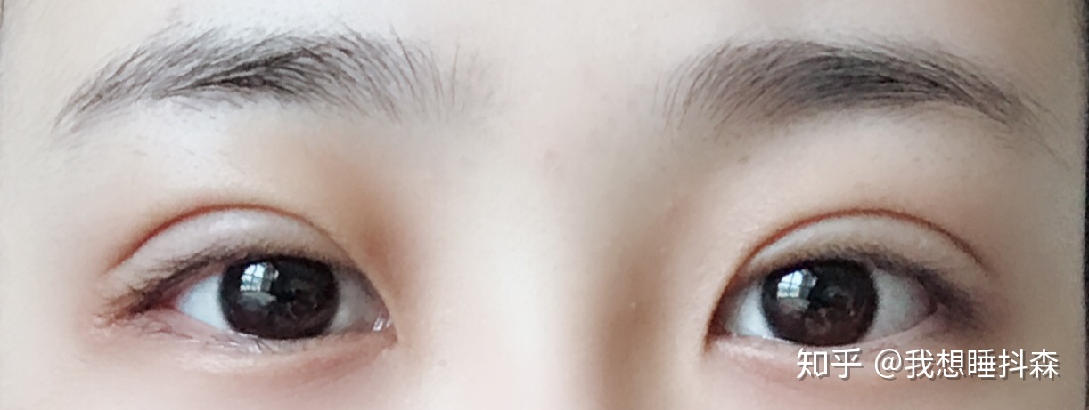 三点双眼皮多久能化妆
