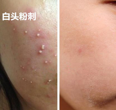 粉刺能用手挤吗