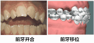 牙齿下颌4图片