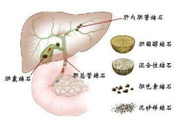 胆管结石怎么治疗好