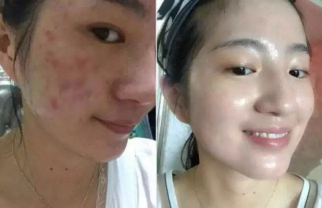 有痘痘痘印的怎么化妆