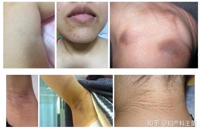 怀孕腋下黑色素沉淀怎么去除
