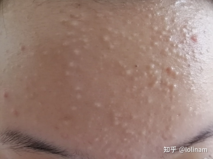 怎样去黑头痘痘