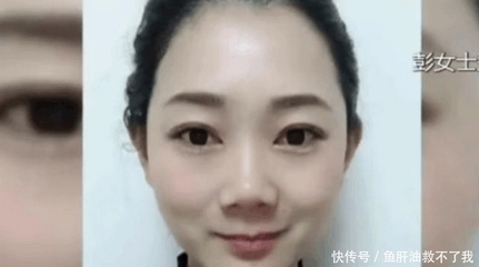 整容双眼皮的危害