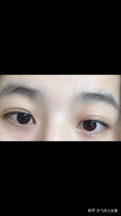 为什么眼皮很松
